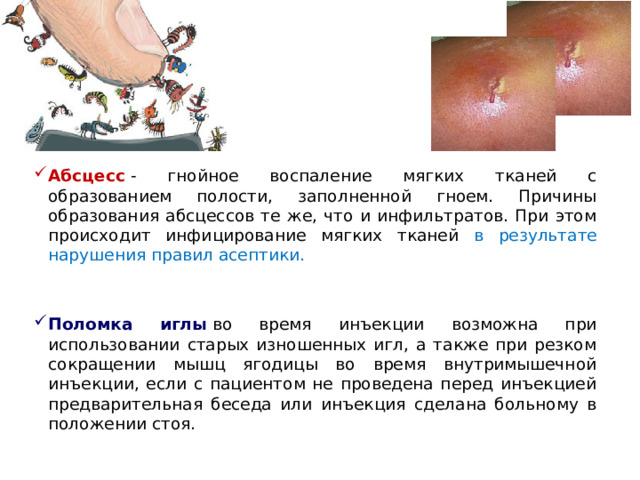 Абсцесс  - гнойное воспаление мягких тканей с образованием полости, заполненной гноем. Причины образования абсцессов те же, что и инфильтратов. При этом происходит инфицирование мягких тканей в результате нарушения правил асептики.    Поломка иглы  во время инъекции возможна при использовании старых изношенных игл, а также при резком сокращении мышц ягодицы во время внутримышечной инъекции, если с пациентом не проведена перед инъекцией предварительная беседа или инъекция сделана больному в положении стоя.     