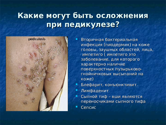 Какие могут быть осложнения при педикулезе? Вторичная бактериальная инфекция (пиодермия) на коже головы, заушных областей, лица,  импетиго ( импетиго это заболевание, для которого характерно наличие поверхностных пузырьково-гнойничковых высыпаний на коже) Блефарит, конъюнктивит. Лимфаденит Сыпной тиф – вши являются переносчиками сыпного тифа Сепсис 