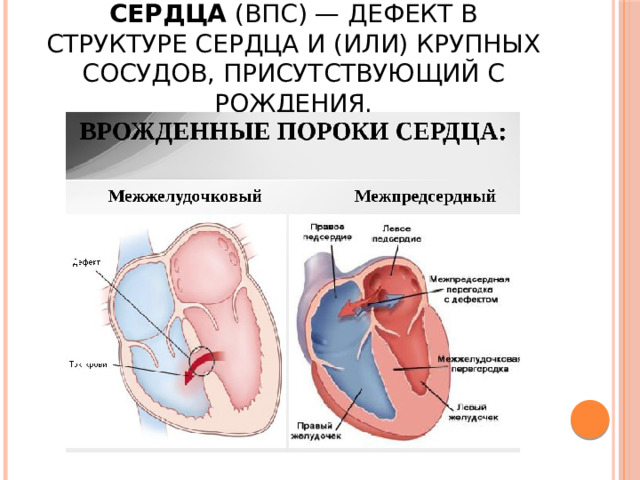 Врождённый порок сердца  (ВПС) — дефект в структуре сердца и (или) крупных сосудов, присутствующий с рождения. 