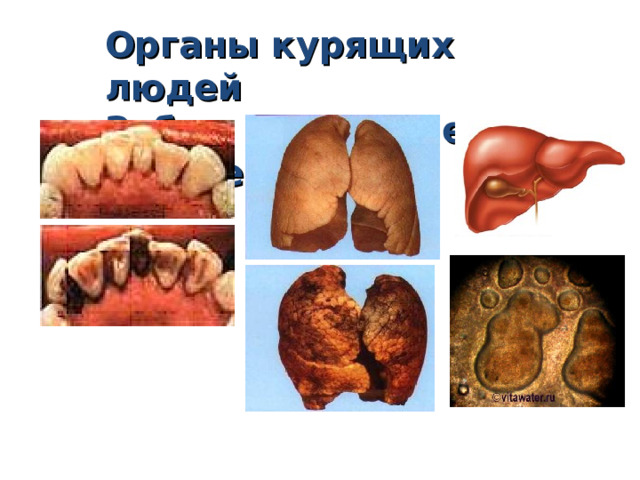 Органы курящих людей Зубы Лёгкие Печень   