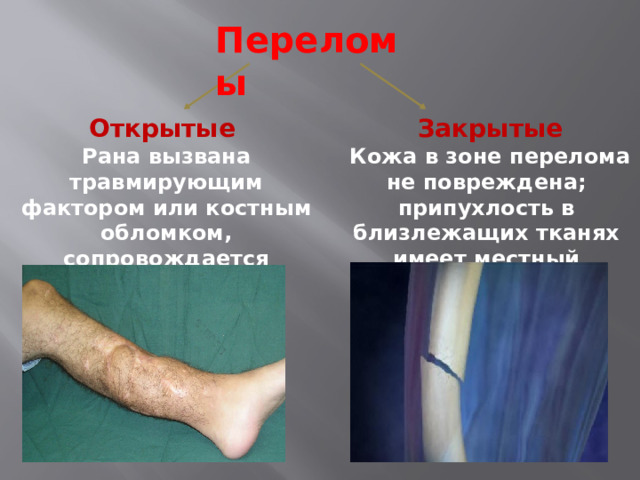 Переломы Открытые   Закрытые Рана вызвана травмирующим фактором или костным обломком, сопровождается кровотечением  Кожа в зоне перелома не повреждена; припухлость в близлежащих тканях имеет местный характер 