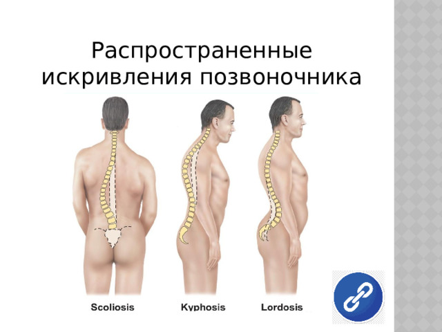 Распространенные искривления позвоночника 