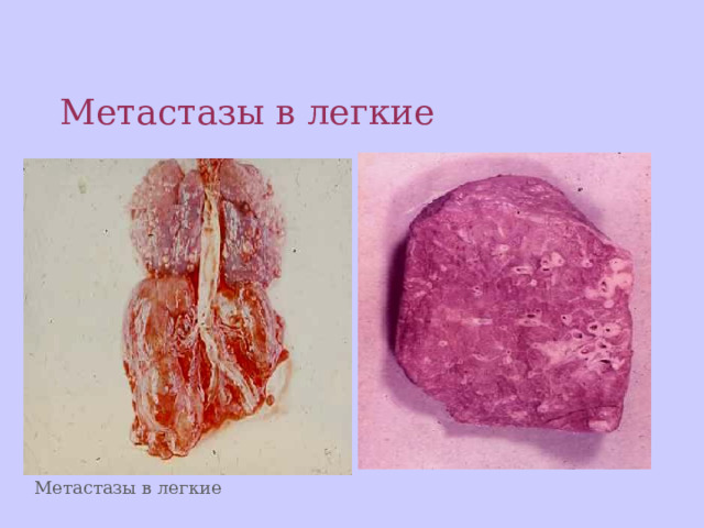 Презентация по основам патологии по теме "Опухоли"