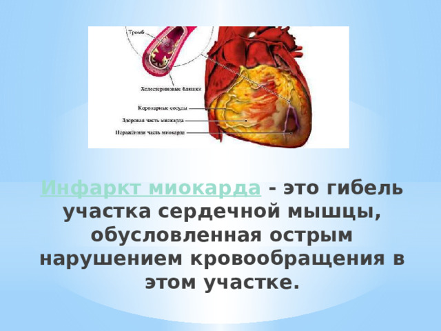 Инфаркт миокарда  - это гибель участка сердечной мышцы, обусловленная острым нарушением кровообращения в этом участке.   