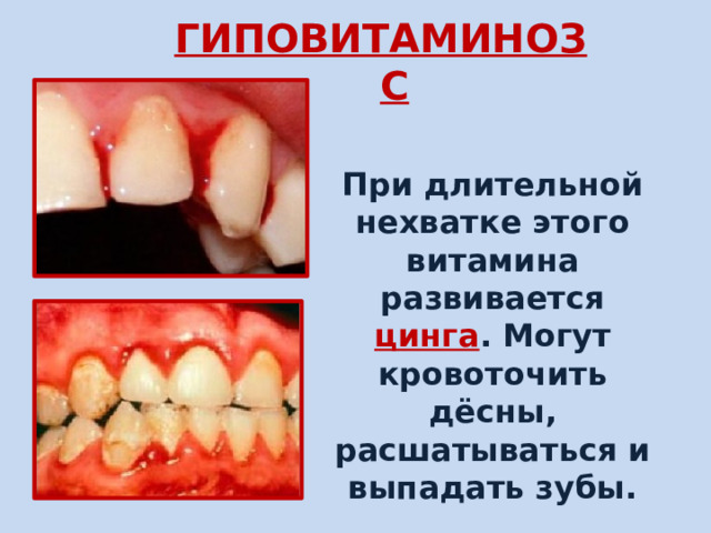 ГИПОВИТАМИНОЗ  С При длительной нехватке этого витамина развивается цинга . Могут кровоточить дёсны, расшатываться и выпадать зубы. 