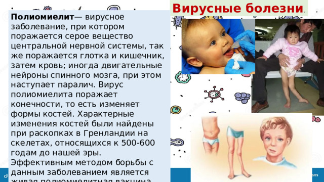 Вирусные болезни . Полиомиелит — вирусное заболевание, при котором поражается серое вещество центральной нервной системы, так же поражается глотка и кишечник, затем кровь; иногда двигательные нейроны спинного мозга, при этом наступает паралич. Вирус полиомиелита поражает конечности, то есть изменяет формы костей. Характерные изменения костей были найдены при раскопках в Гренландии на скелетах, относящихся к 500-600 годам до нашей эры. Эффективным методом борьбы с данным заболеванием является живая полиомиелитная вакцина . Прививание новорожденных детей является обязательным делом. 