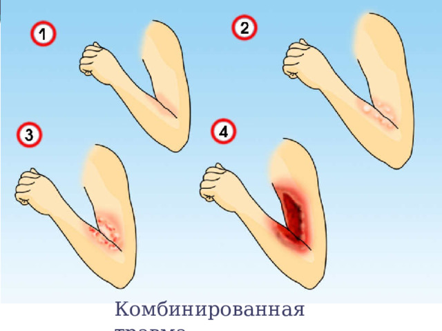 Комбинированная травма 