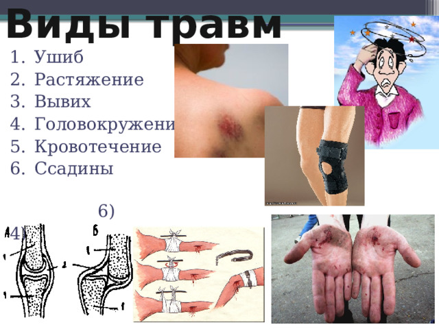 Виды травм Ушиб 1) 3) Растяжение  Вывих Головокружение Кровотечение Ссадины 2)  6) 4) 5) 