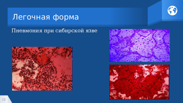 Легочная форма Пневмония при сибирской язве 1 