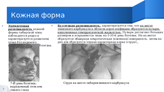 Кожная форма Буллезная разновидность.  характеризуется тем, что  на месте типичного карбункула в области ворот инфекции образуются пузыри, наполненные геморрагической жидкостью. Пузыри достигают больших размеров и вскрываются лишь на 5-10-й день болезни. На их месте образуется обширная некротическая (язвенная) поверхность. затем на дне язв образуется черная характерная корка (струп).   Эдематозная разновидность  кожной формы сибирской язвы наблюдается редко и характеризуется развитием отека без видимого карбункула в начале болезни. Струп на месте сибиреязвенного карбункула 7-Й день болезни; выраженный отек век левого глаза 1 