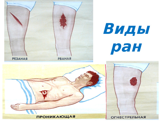 Виды ран 