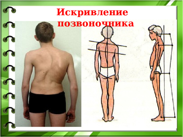 Искривление позвоночника 