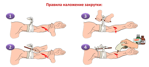 Вместо жгута можно использовать закрутку. Техника наложения кровоостанавливающего жгута и жгута-закрутки. Наложение жгута закрутки при артериальном кровотечении алгоритм. Правила наложения жгута закрутки при кровотечении. Наложение кровоостанавливающего жгута алгоритм.