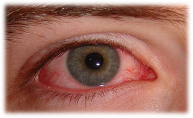 Первая помощь при повреждении глаз при близорукости