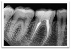 Рентгеновский Снимок Зуба Фото